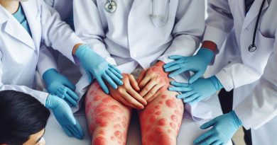 The Involvement Of Dermatologists In The Treatment Of Hives