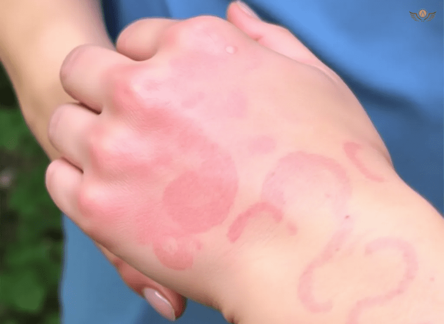 Dermatologists And The Treatment Of Poison Ivy Rashes