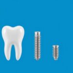 Are Dental Implants Painful: Debunking Common Myths