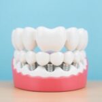 Do Dental Implants Ever Help in Boosting Your Smile?