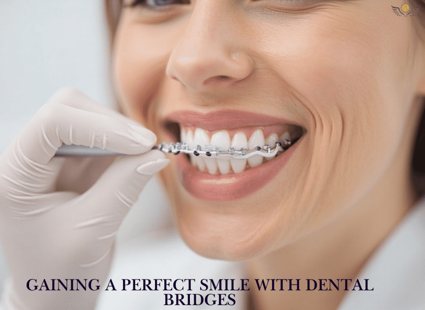 Gaining A Perfect Smile With Dental Bridges