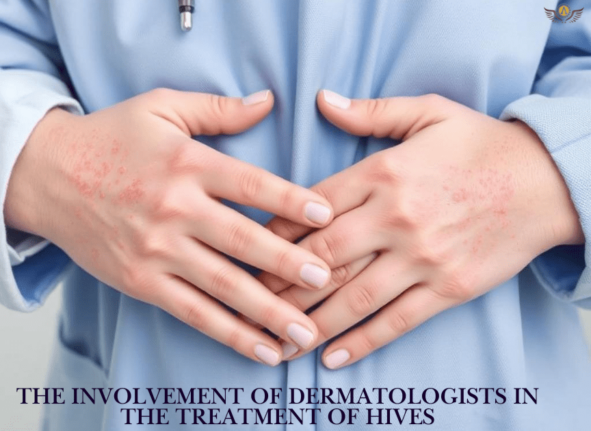 The Involvement Of Dermatologists In The Treatment Of Hives